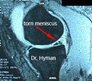 image MRI image of a torn medial meniscus