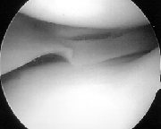 image Vertical tear posterior horn