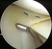 image Dissolvable meniscus sutures