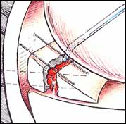 image Blood inside acts as a fibrin glue for healing