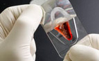 Pioneering Cartilage Restoration Surgery - DeNovo NT