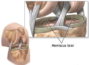 image Inner edge tears don't heal (no blood supply)