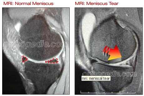 What is the recovery time for a minor meniscus tear surgery?