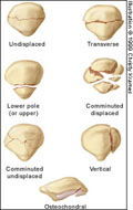 image Patella Fracture Patterns