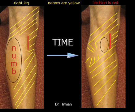 image Numbness shrinks away over time